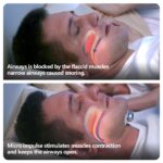 Smart Anti Snoring Device Electronic Muscle Stimulator Pro - Image 4